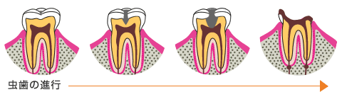 虫歯の進行