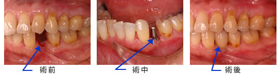 インプラントの症例